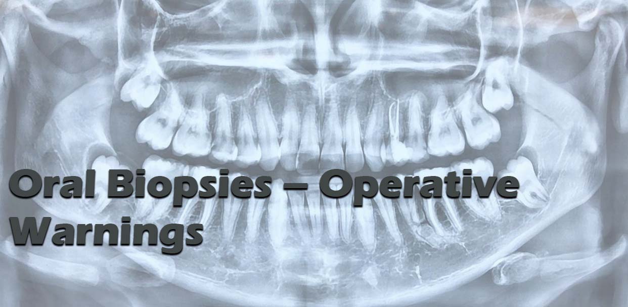 Oral Biopsies – Operative Warnings